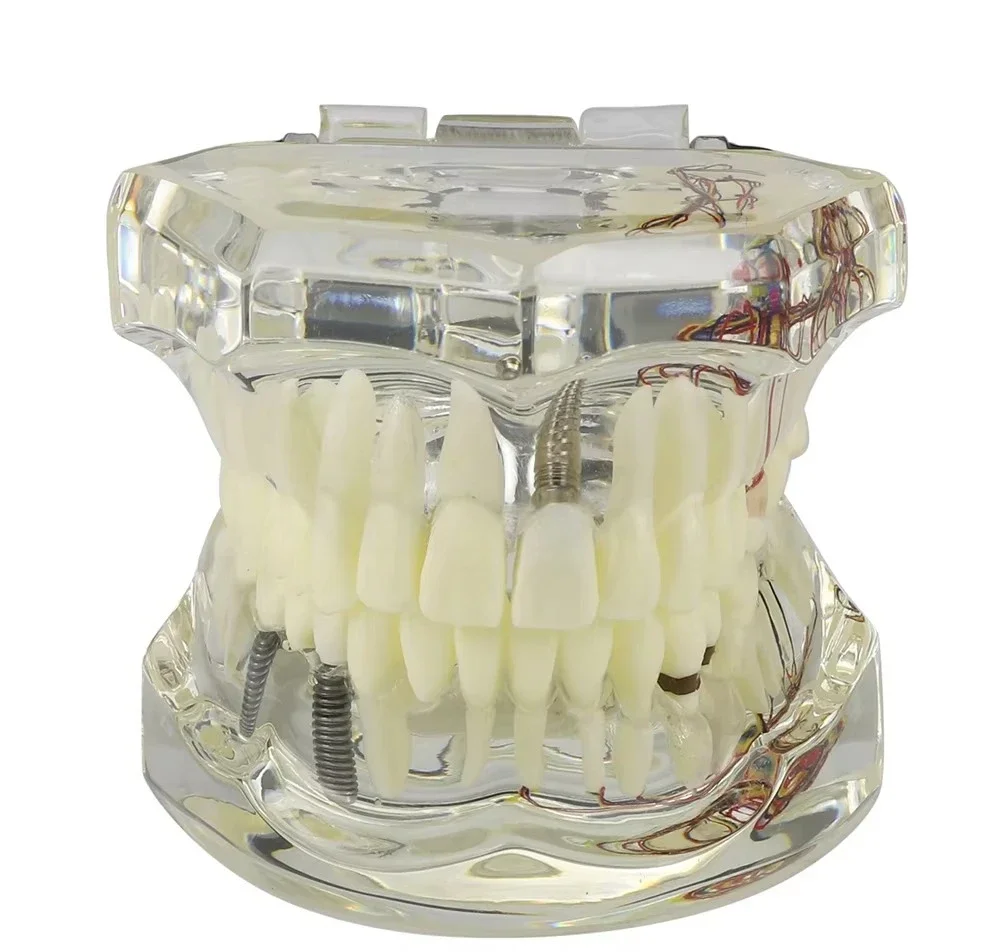 Dentals Implants Restoration Bridge Teaching Research Medical Diseases Dentals Model