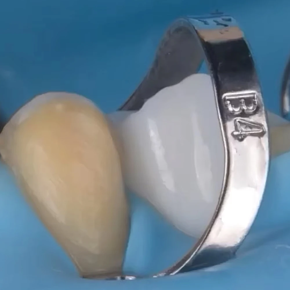 

1 шт., 3 шт., стоматологические зажимы B4, резиновые зажимы из нержавеющей стали, эндодонтические восстанавливающие барьерные зажимы, набор инструментов для ортодонтической стоматологии