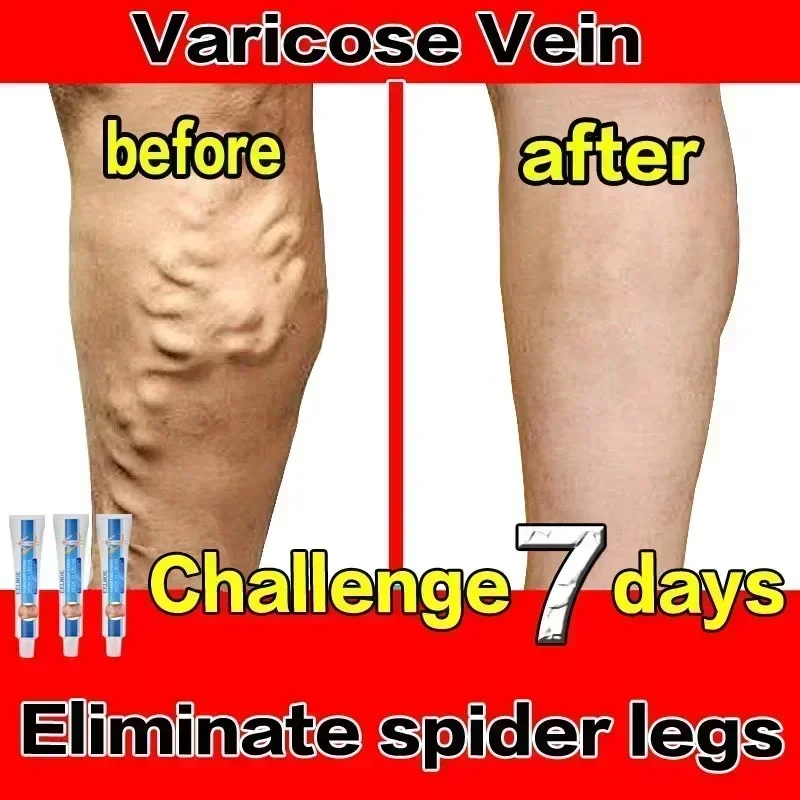 

Varicose vein 7 days Effective to Relieve Vasculitis Phlebitis Spider Pain Treatment ointment against varicose veins