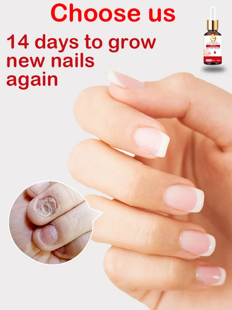 Laser Light Solves Nails Problems