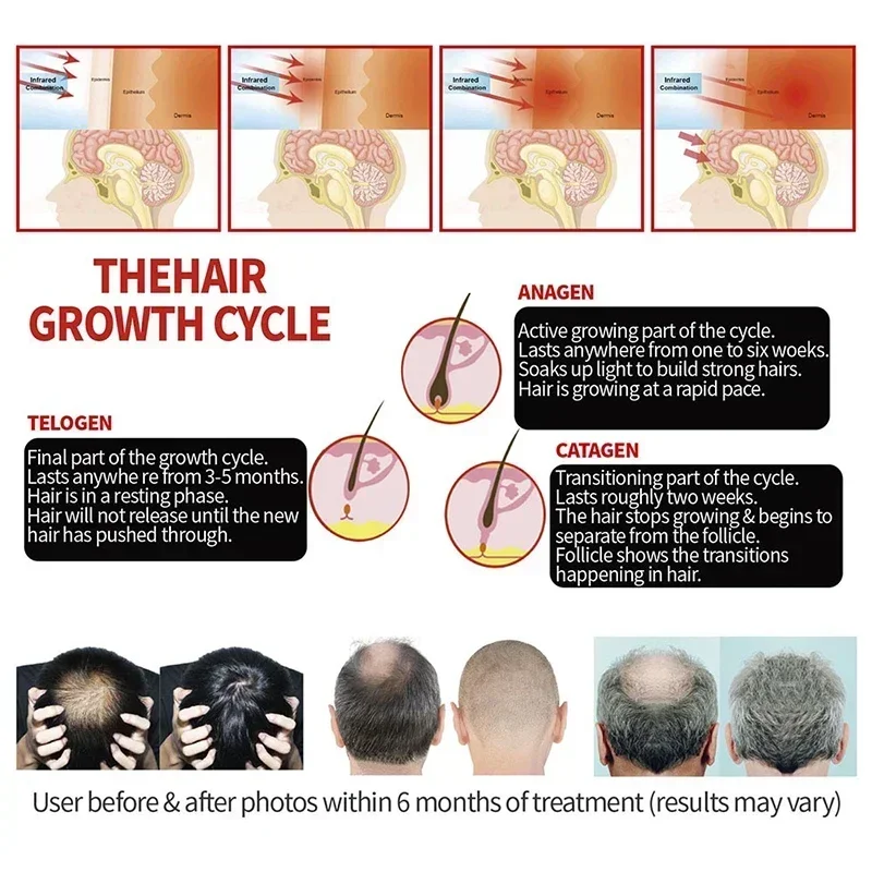 髪の治療のための赤外線放射療法キャップ,sebordic,alopecia,areata,髪の成長,帽子のデバイス,70個