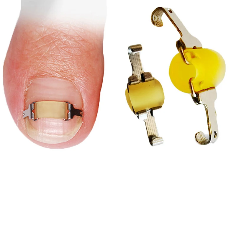 Ingrown Toenail Corrector Ferramentas, Pedicure, Profissional, Pé Care Tool, Embed, Recuperar, Unha Tratamento