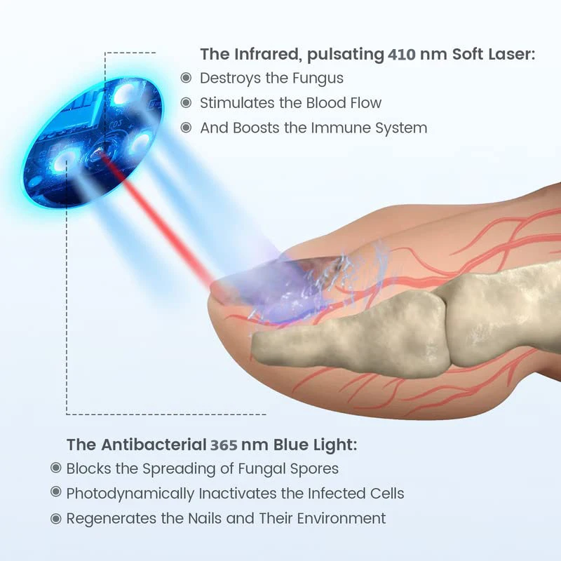 Rechargeable Nail Fungal Treatment Laser Device Fungus Nails Repair Fast Effectively Remove Fungal Nail Repair Solution FootCare