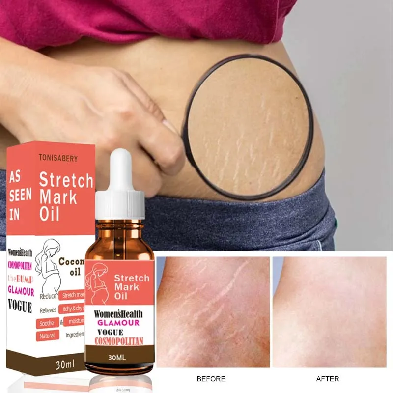 Stretch Marks Remover Essential Oil Pregnancy Maternity Body New Old Stretch Mark Removal Serum Increase Elasticity of Skin