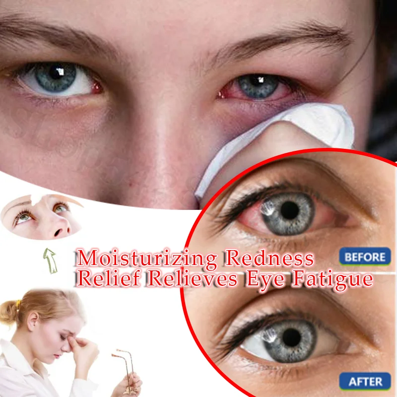 Moisturizing Eye Care Solution Repairs Cornea, Removes Redness and Relieves Eye Fatigue 15ml