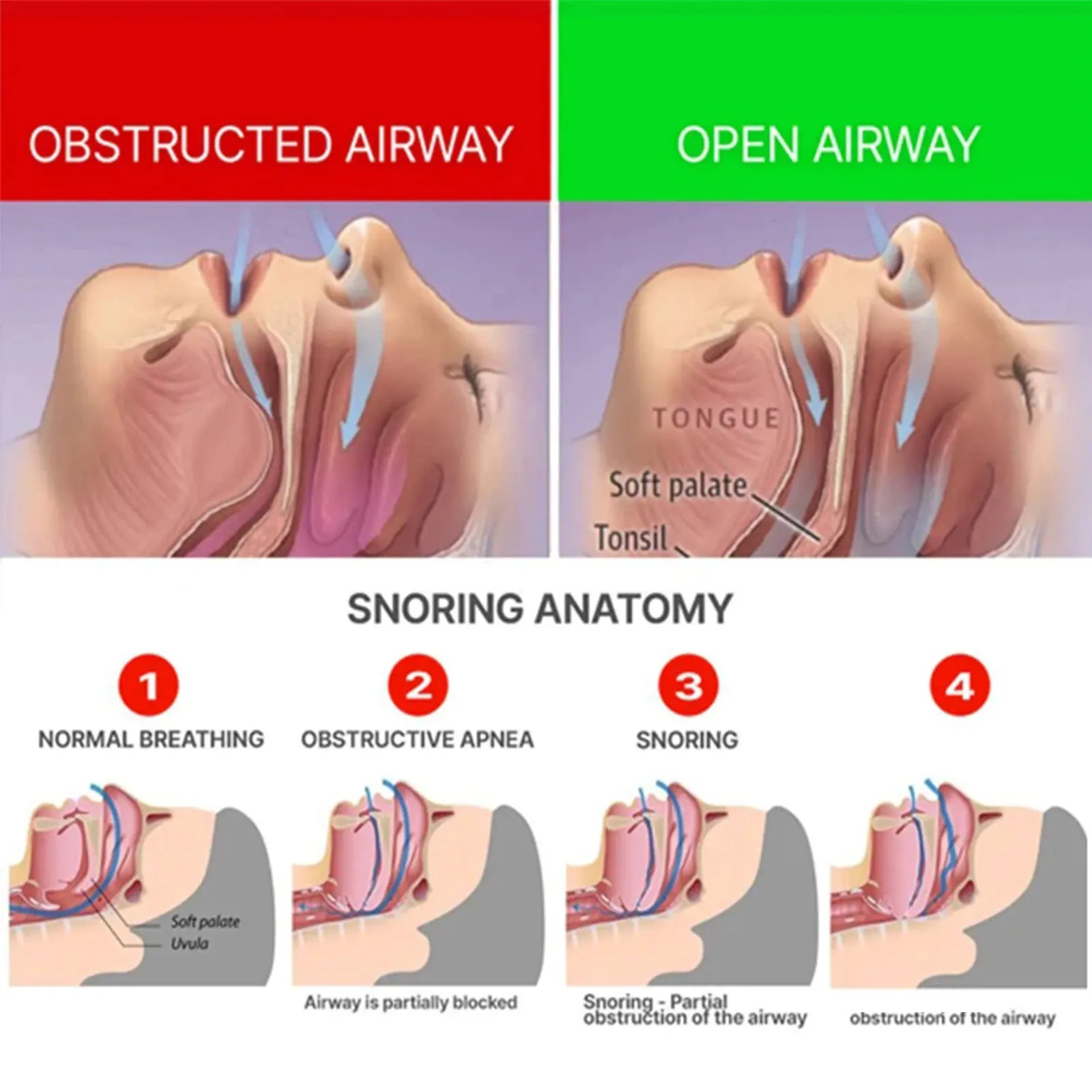 Eelhoe-aparatos antirronquidos para rechinar los dientes, Protector bucal de respiración, bandeja Dental, dispositivo para dejar de roncar, mejora el sueño