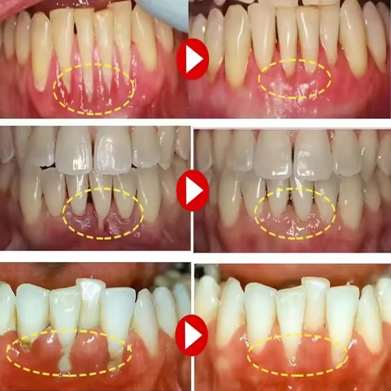 Teeth Whitening Gel Gum Repair Care Improve Gingival Damaged Inflammation Cleaning Stains Whitener Gum Protection for Oral