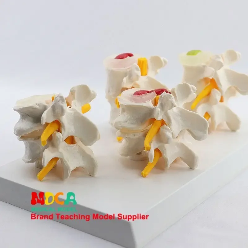 

Четырехтип, комбинированная модель поясничного отдела позвоночника, нормального и поясничного отдела позвоночника и поражения, модель человеческого скелета, скелета, медицинское обучение