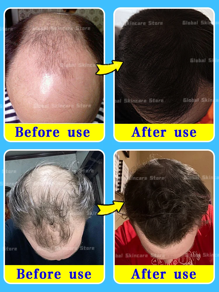 98% of buyers buy again, have more and more hair, say goodbye to baldness, thick hair,Hot selling product