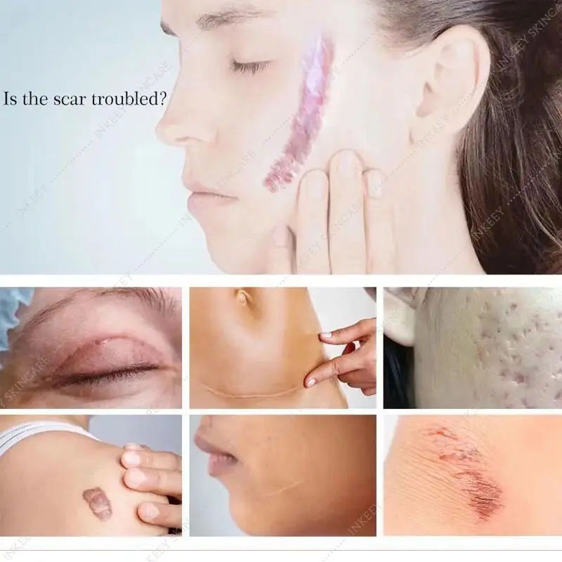 Scar Removal Cream Fade Acne Scar Spots Treatment Stretch Marks Burn Surgical Scar Repairing Cream New Old Scars Gel Skin Care