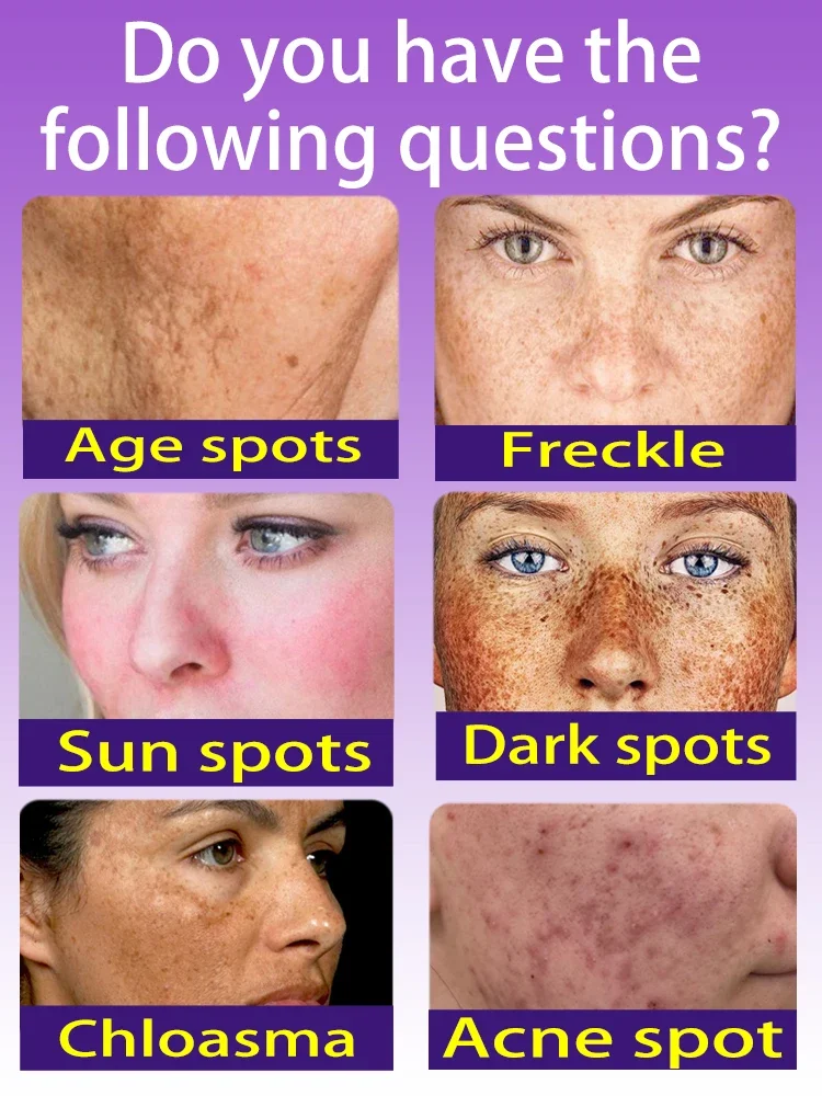 Freckles Melasma Melasma Dark Spots on Face Blu-ray pen