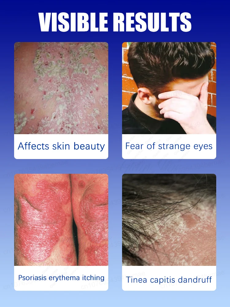 Healthy skin, happy self  ᴏᴠᴇʀᴄᴏᴍᴇ ɪᴛᴄʜɪɴɢ, ᴄᴏᴍғᴏʀᴛᴀʙʟᴇ ᴇᴠᴇʀʏ ᴅᴀʏ