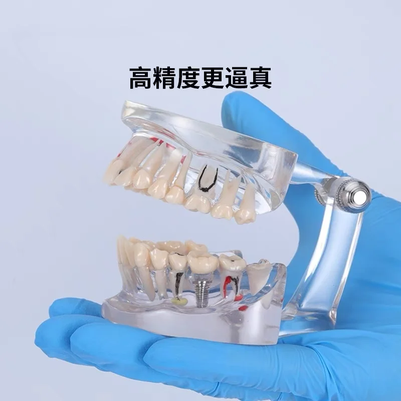 

Removable Teeth Model Implant Disease Dentist Studying New Dental Model Teeth Implant Restoration Bridge Teaching Demonstration