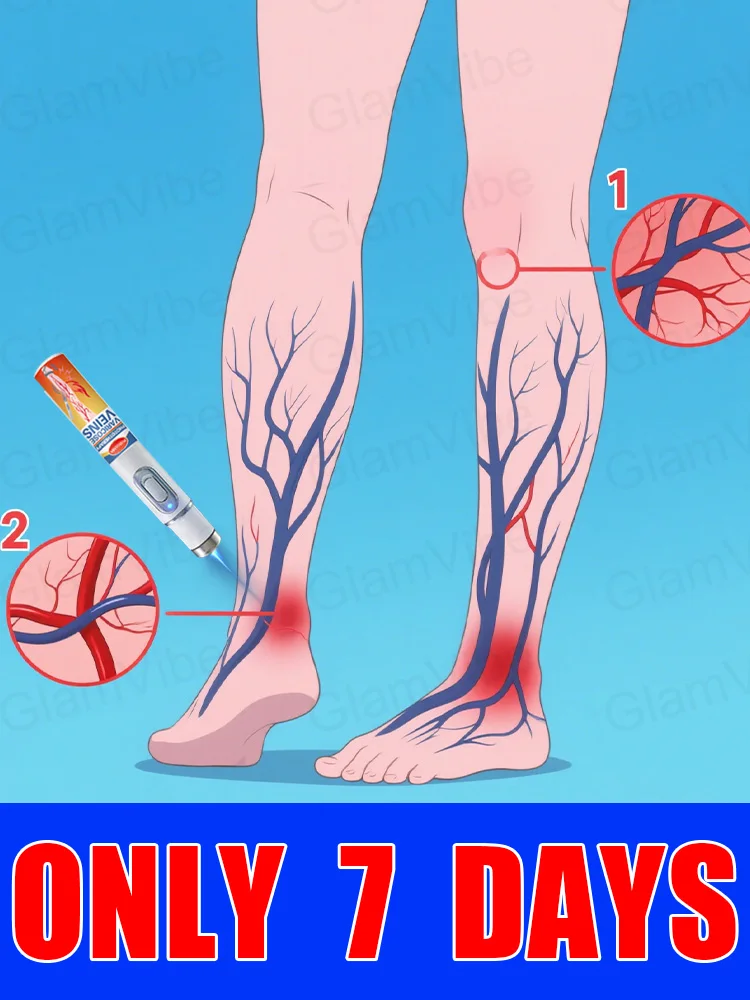 

Generation-2 Laser Says Goodbye To Spider Legs Varicose In 7 Days