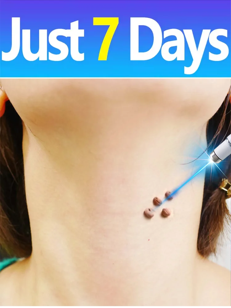 

The first generation of improved wart repair agent wart root fast