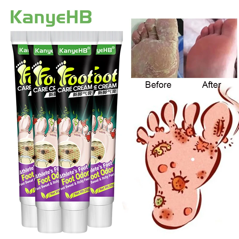 1-2-4pcs Athletes Foot Tinea Ointment Remove Foot Odor Beriberi Treatment Ointment Inhibit Fungal Infection Fast Itching Cream