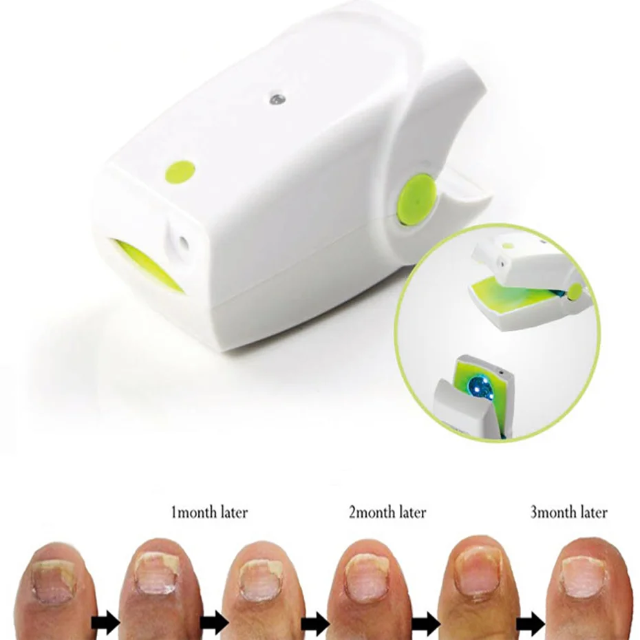 Nail Toenail Fungus Fungi Fungal Treatment Laser Therapy Device 905nm and 470nm Light Therapy