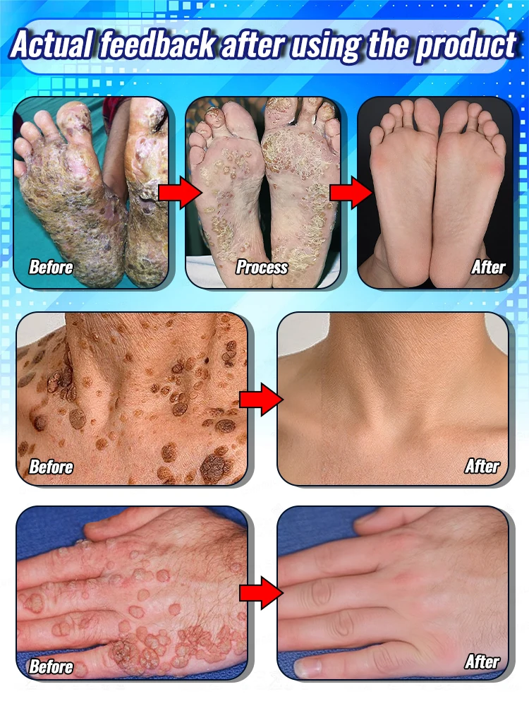 

Новое обновление, эксперимент по здоровью кожи, защитите здоровье кожи.