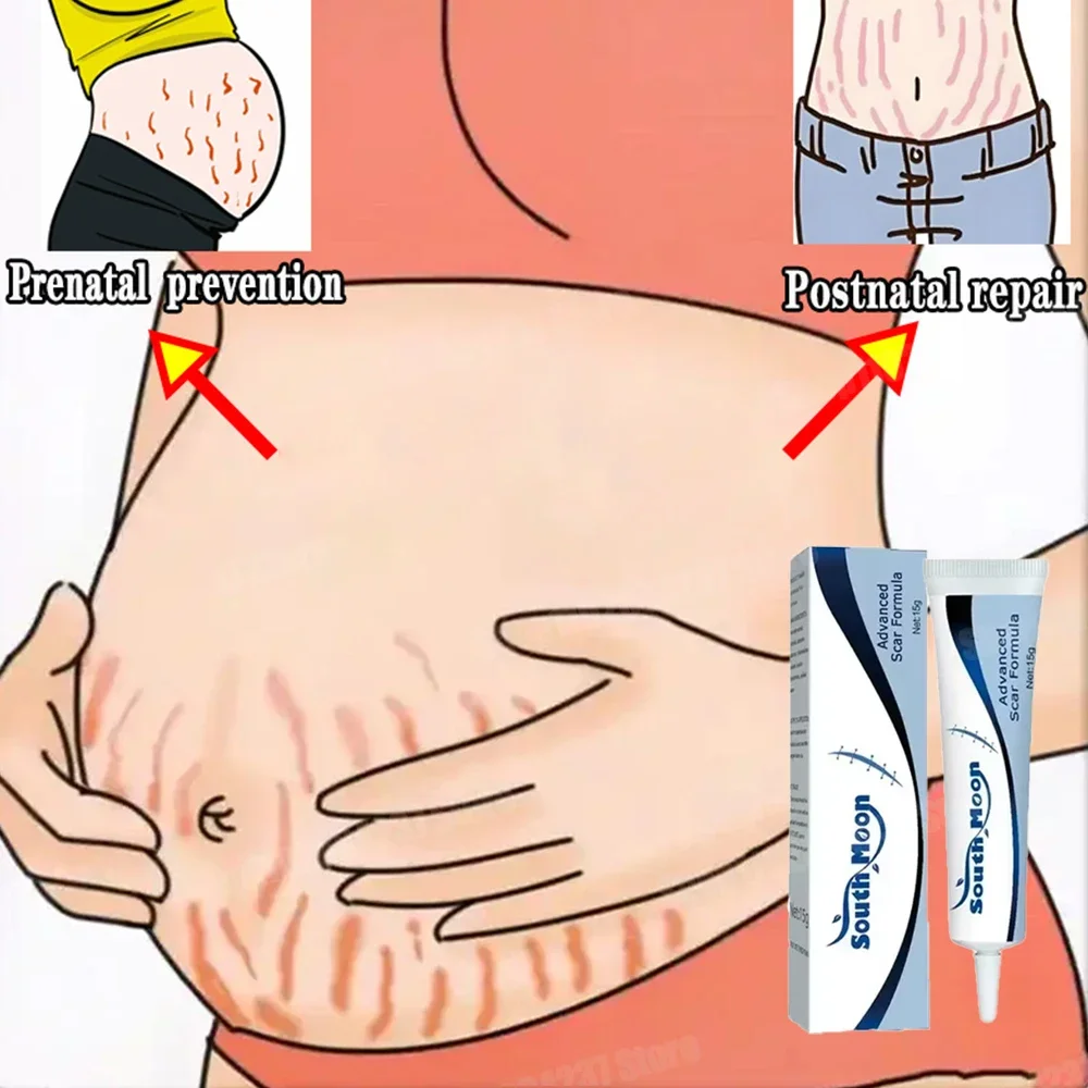 

Remove Stretch Marks Pregnant Women Eliminate Thigh Growth Lines Obesity Lines Skin Care For Pregnant Women Firmness Smooth