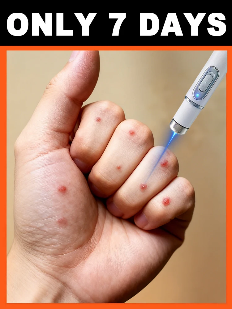 

Лазерная ручка глубоко удаляет бородавки, помогает снижает кожу и снижает разрушение.