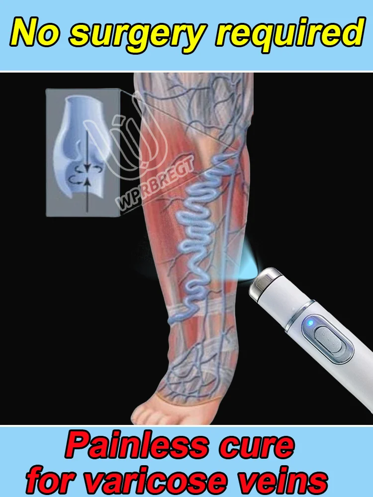 

New upgraded nanotechnology for varicose vein treatment and spider vein treatment