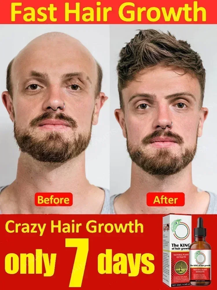 Fast Hair Growth Oil Baldness Repair Hereditary Hair Loss Postpartum Hair Loss Seborrheic  Effective Fast Growth