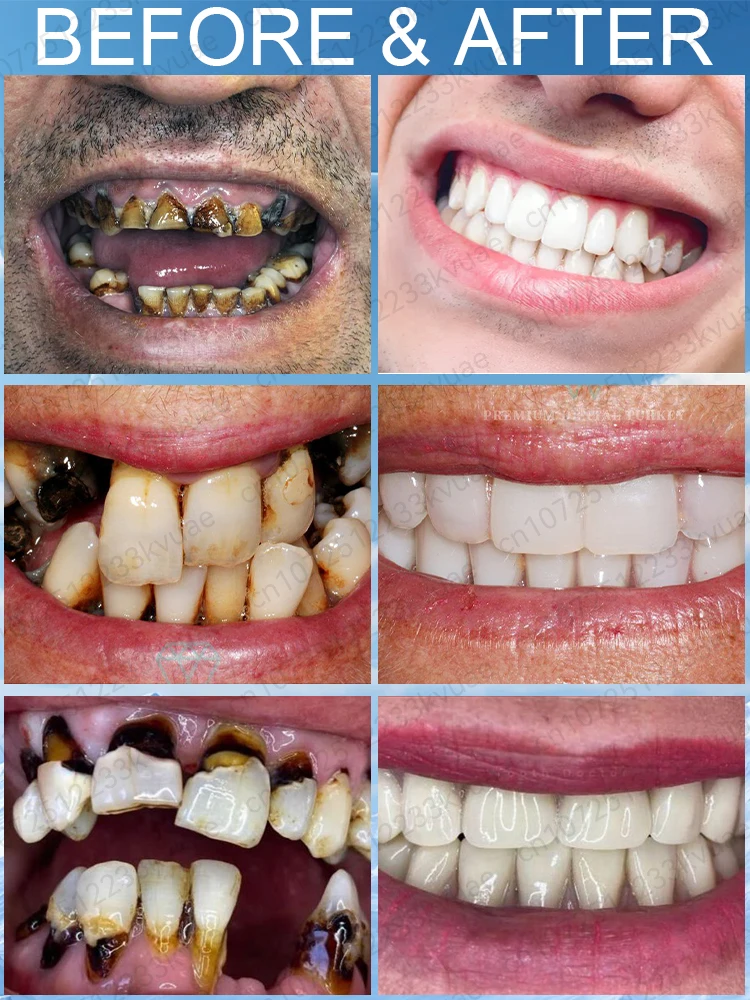 Reparo científico do flúor, remoção das manchas dentárias, venda especial