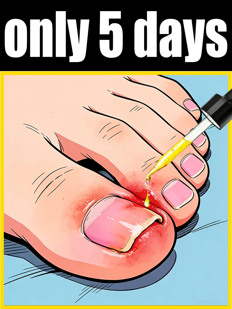 

Eʟɪᴍɪɴᴀᴛᴇ ғᴜɴɢᴀʟ ɴᴀɪʟs Rapid penetration, restoring nails to their natural shine. Say goodbye to fungal nails