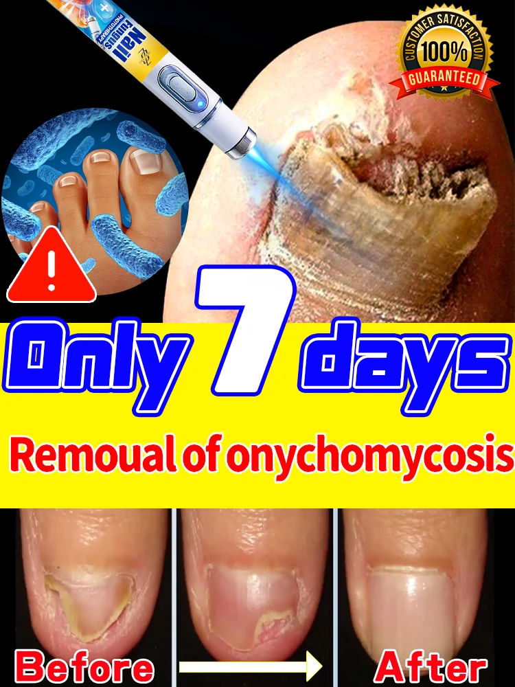 Les ongles deviennent sains et lisses sans avoir à se soucier des mycoses.