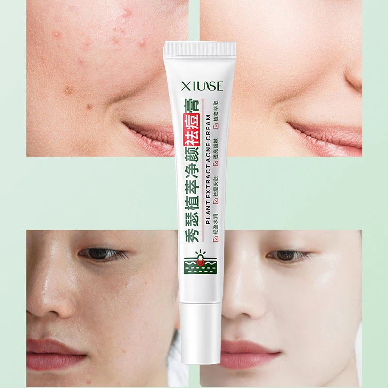 Plant Extract Clear Face Acne Cream 20g Moisturizing Lightweight Moisturizing Soft Skin Facial Acne Cream Skin Care Products