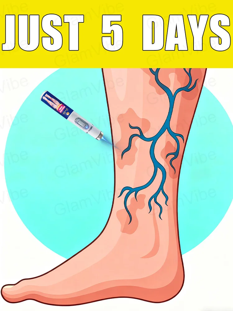 

Generation-2 Laser Says Goodbye To Spider Legs Varicose In 7 Days