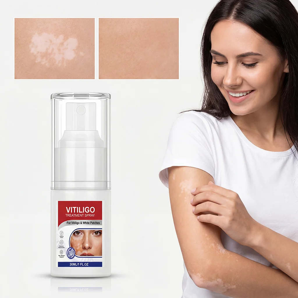 Vitiligo Treatment Spray Improves White Spots Melanin Activation Repairs Skin Barrier Deep Hydration Relieves Skin Sensitivity