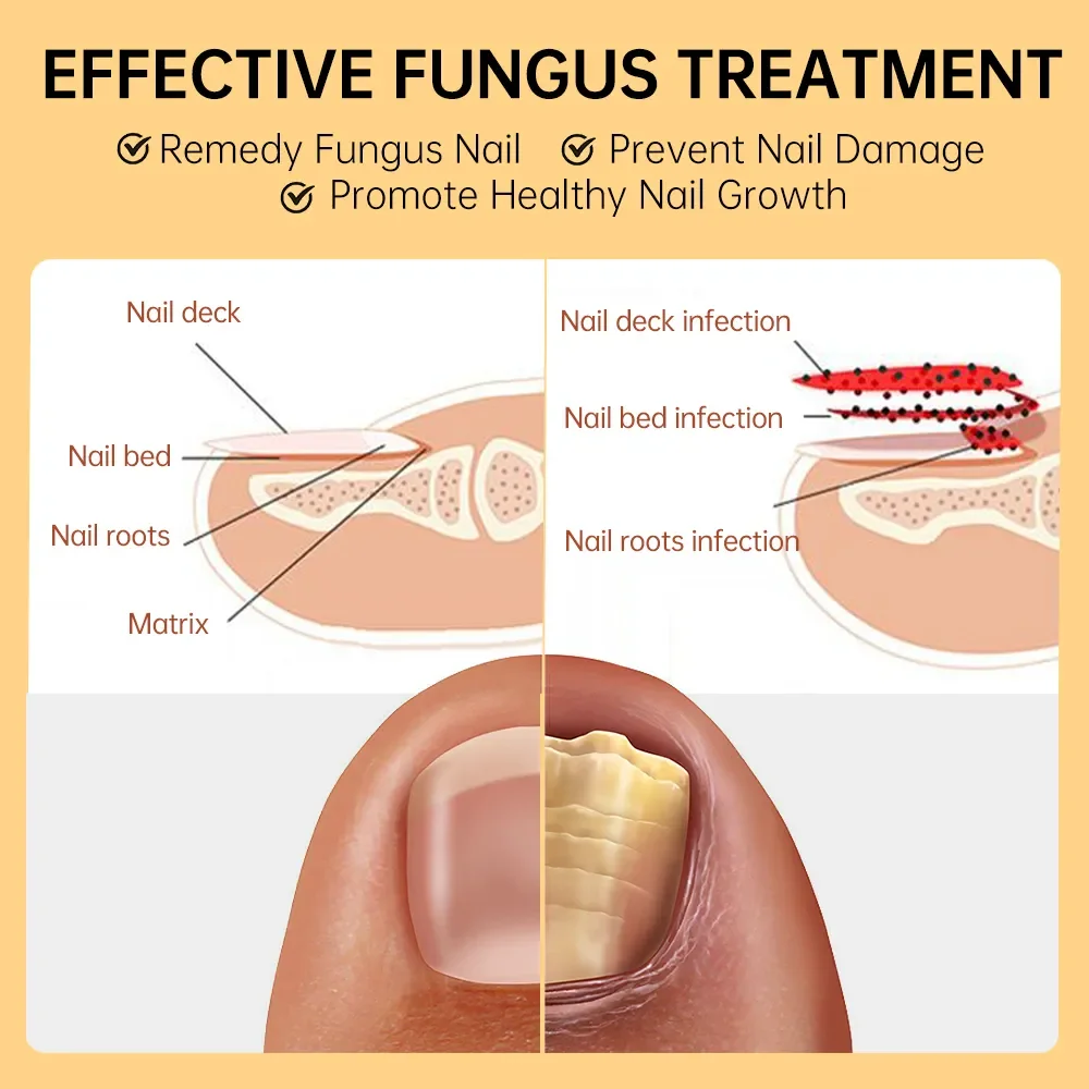 Fungal Nail Treatment Device Repair Fast Nails Fungus Onychomycosis Repair Toenail Fingernail Removes Nail Fungus Foot Care