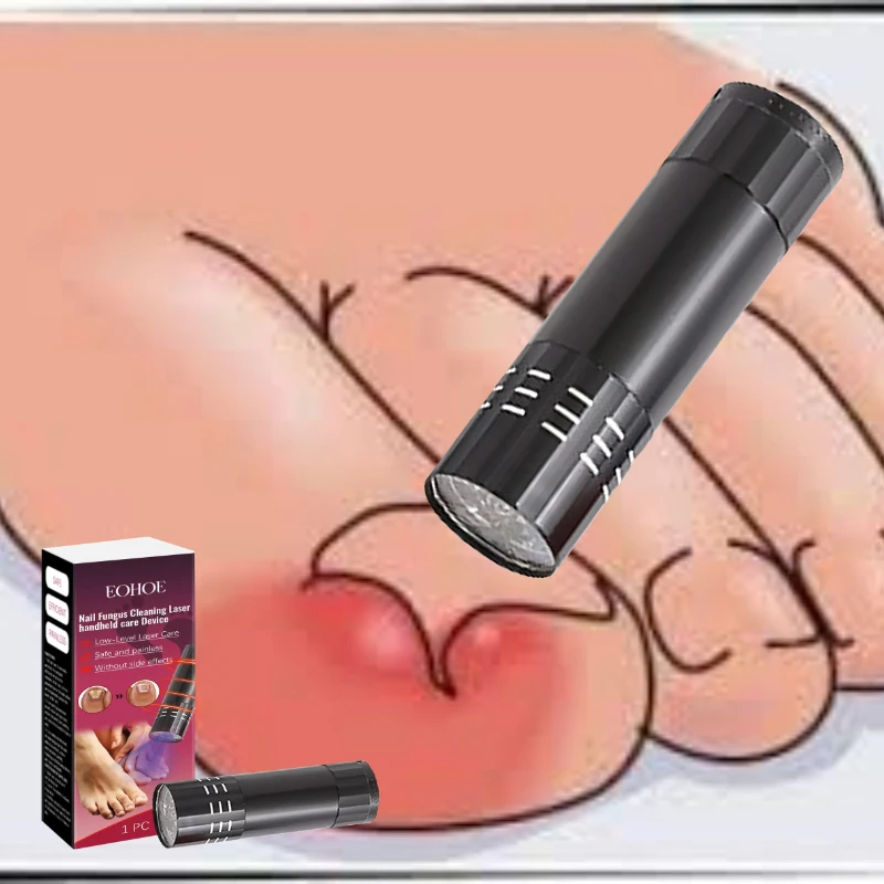 

Портативная лазерная ручка для ремонта ногтей на ногах и ремонта инфекций в расчесывания