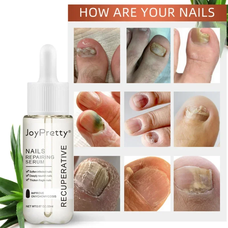 20Ml Nagelreparatie Vloeibare Nagels Serum Vingernagel Oplossing Teennagel Voedende Kracht Zorg Essentie Reparatie Beschadigde Groei Uña 'S