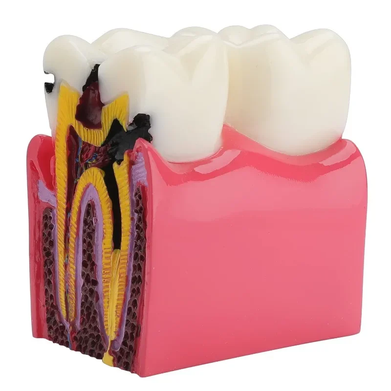 Dental  6Times Caries Teeth Model  Anatomy Education Model  Caries Bilateral Comparison Study Model Tooth Decay Props Teaching