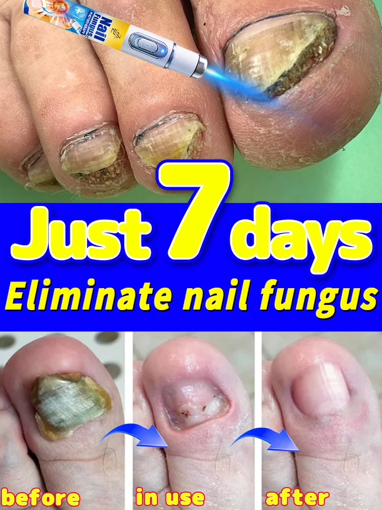 Used to eliminate fungal toenails. Prevents fungal infections, no nail problems, antibacterial and anti-inflammatory.