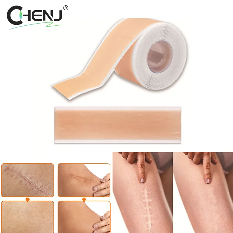 1 rolo 4x150cm silicone cicatriz remendo folhas de reparo da pele remoção auto-adesivo estiramento marke queimar acne cicatriz fita ferramenta de cuidados com a pele