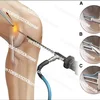 Konkurrenzfähiger Preis Knie Femoral Ligament Rekonstruktion Einstellbare Fixierung Knotless Button Endobutton Loop 4