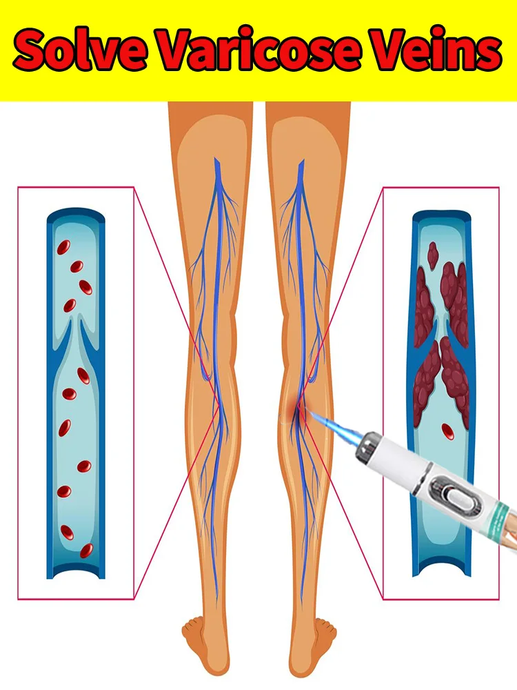 

Advanced Vein Laser Pen for Legs