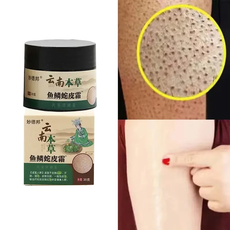 Chicken Skin Repair Cream Curing Keratosis Follicle Pilaris Body Dark Spot Remove Thick Pores Moisturizing Smooth Essence