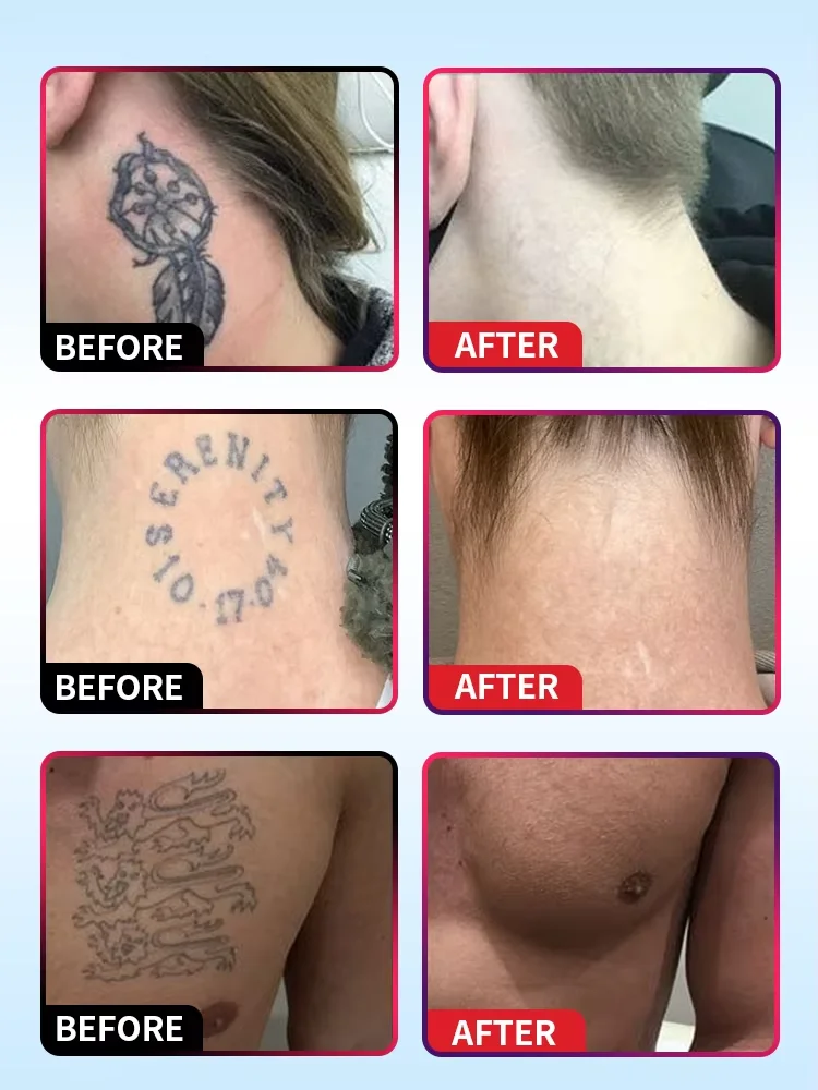 2025-spray voor het verwijderen van tatoeages Gepigmenteerde permanente make-up-tatoeageverwijdering