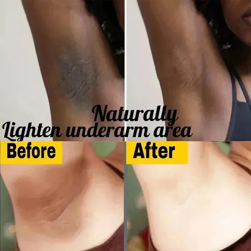 Body Whitening Cream Dark Skin Armpit Lightening Intimate Areas Underarm Bleaching Private Parts Whiten Cream Body Lotion Beauty - Image 2