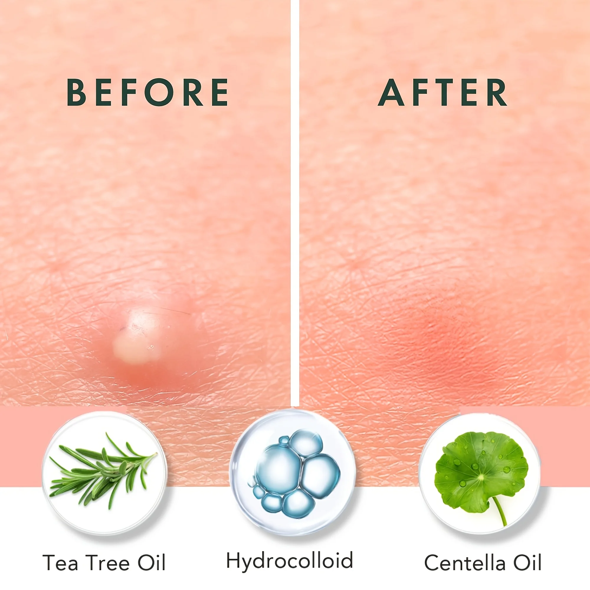 200/400/800pcspcs acne patches, water-based gel non irritating, suitable for all skin types image 4