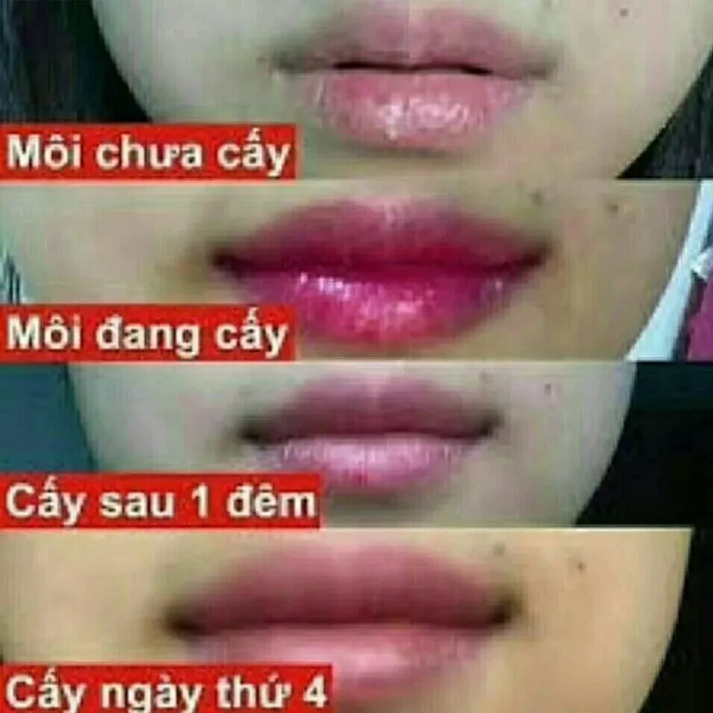 Cấy Môi Vaura Xóa Thâm Làm Hồng Môi , Babier Lips Volume V3 Tinh chất cấy hồng môi 1pcs