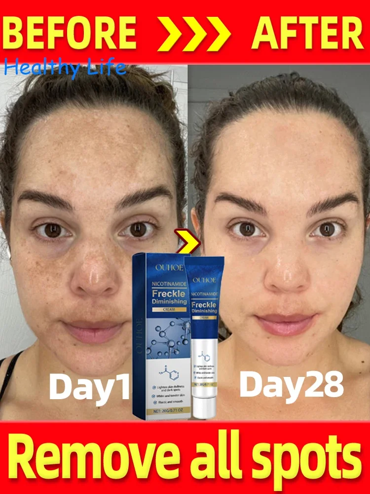 

Nicotinamide Brightening Chloasma Cream Effective Lightening Dull Brighten Cream Face Fade Melasma Korean Moisturizing Skin Care