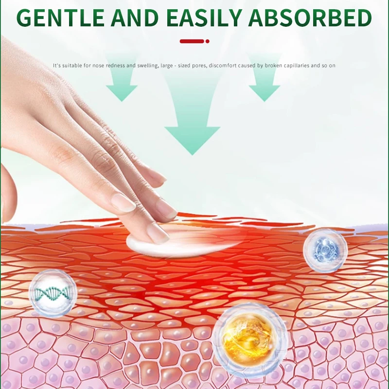 Rosacea-zalf - een actuele gezondheid - Verzorgingspasta voor neusroodheid, vergrote poriën, gebroken capillaires, mee-eters en gerelateerde drosacea-zalf - Een actuele gezondheid - verzorgingspasta voor neusroodheid, vergrote poriën, gebroken