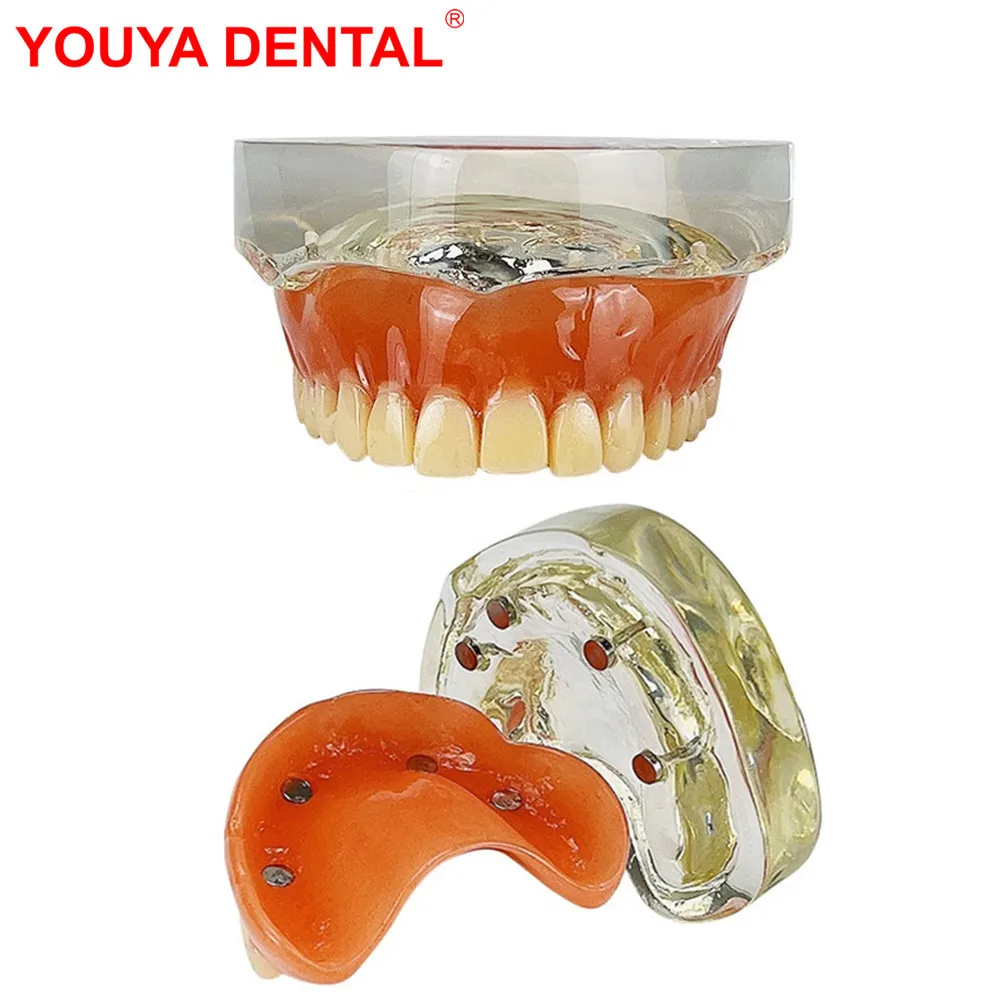 Dental Model Teeth Implant Restoration Models Removable Bridge Dentistry Upper Overdenture Model For Teaching Studying Education