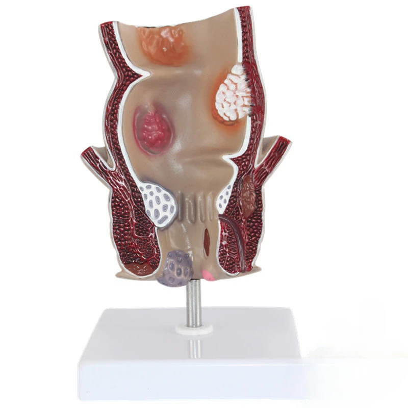 Rectal pathology model, hemorrhoid model, anorectal disease demonstration