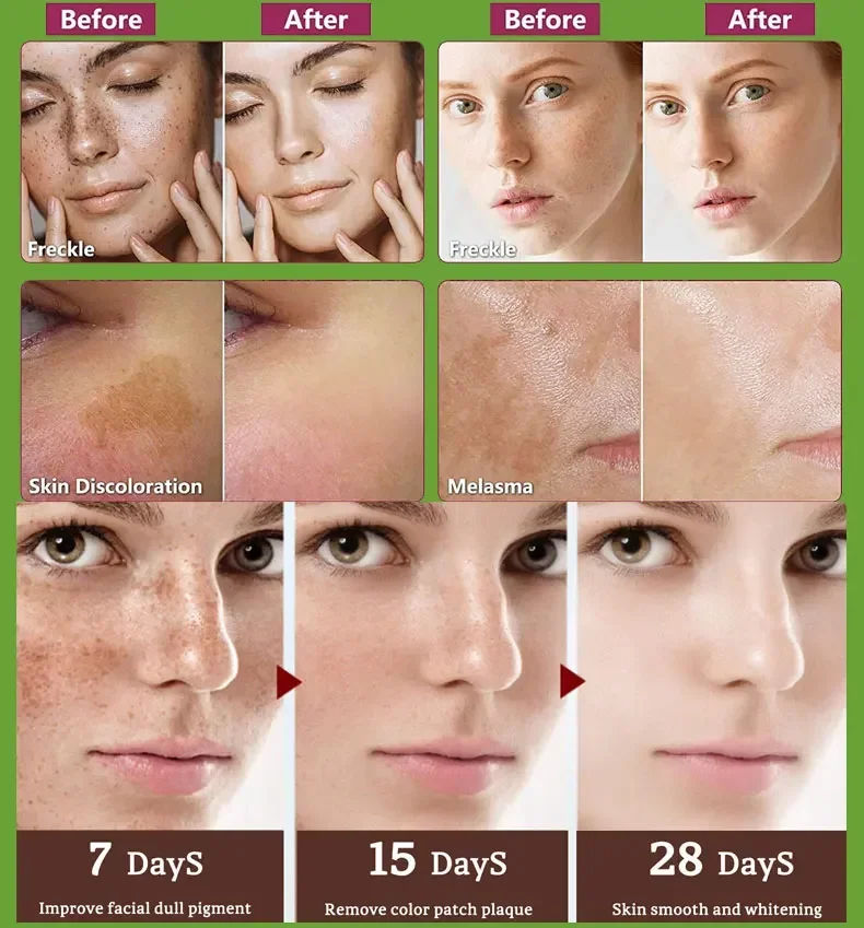 Crema para eliminar pecas, crema para eliminar manchas oscuras de la piel, manchas de la edad, manchas solares, blanqueamiento y pecas